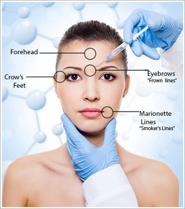 botox-labeled-image