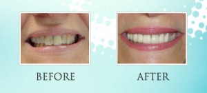 Dental Crowns at Loukas Dentistry in Park Ridge IL