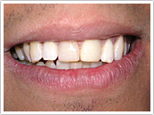 After Dental bonding repair