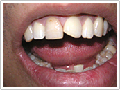 Before Dental bonding repair