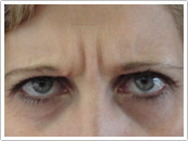 Before Forehead Botox treatment