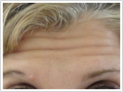 Before Botox treatment results