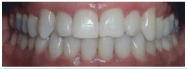 After Crossbite correction