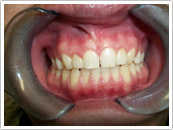 After Dental crown restoration