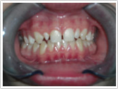 Before Dental crown restoration