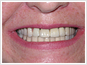 After Custom denture fitting