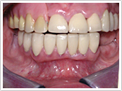 Before Custom denture fitting