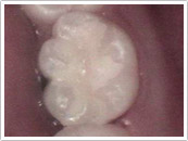 After Composite filling restoration