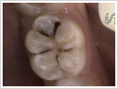 Before Composite filling restoration
