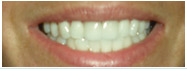 After Professional teeth whitening