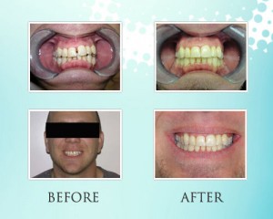 Invisalign Results – Park Ridge IL