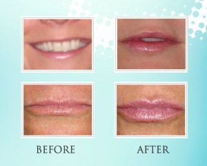 Juviderm .jpg Juviderm at Loukas Dentistry in Park Ridge IL