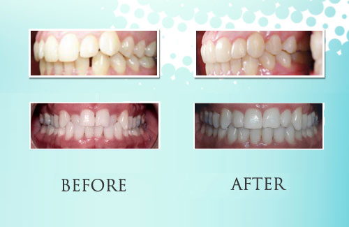 Invisalign Park Ridge IL