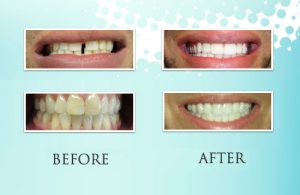 Teeth Whitening at Loukas Dentistry in Park Ridge IL