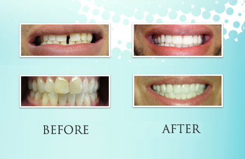 Park Ridge Teeth Whitening