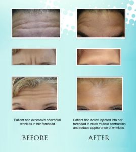 Botox Treatment at Loukas Dentistry in Park Ridge IL