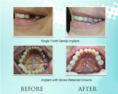 Dental Implant in Park Ridge