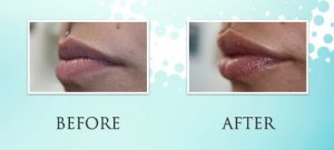 Lip Filler Treatment at Loukas Dentistry in Park Ridge IL