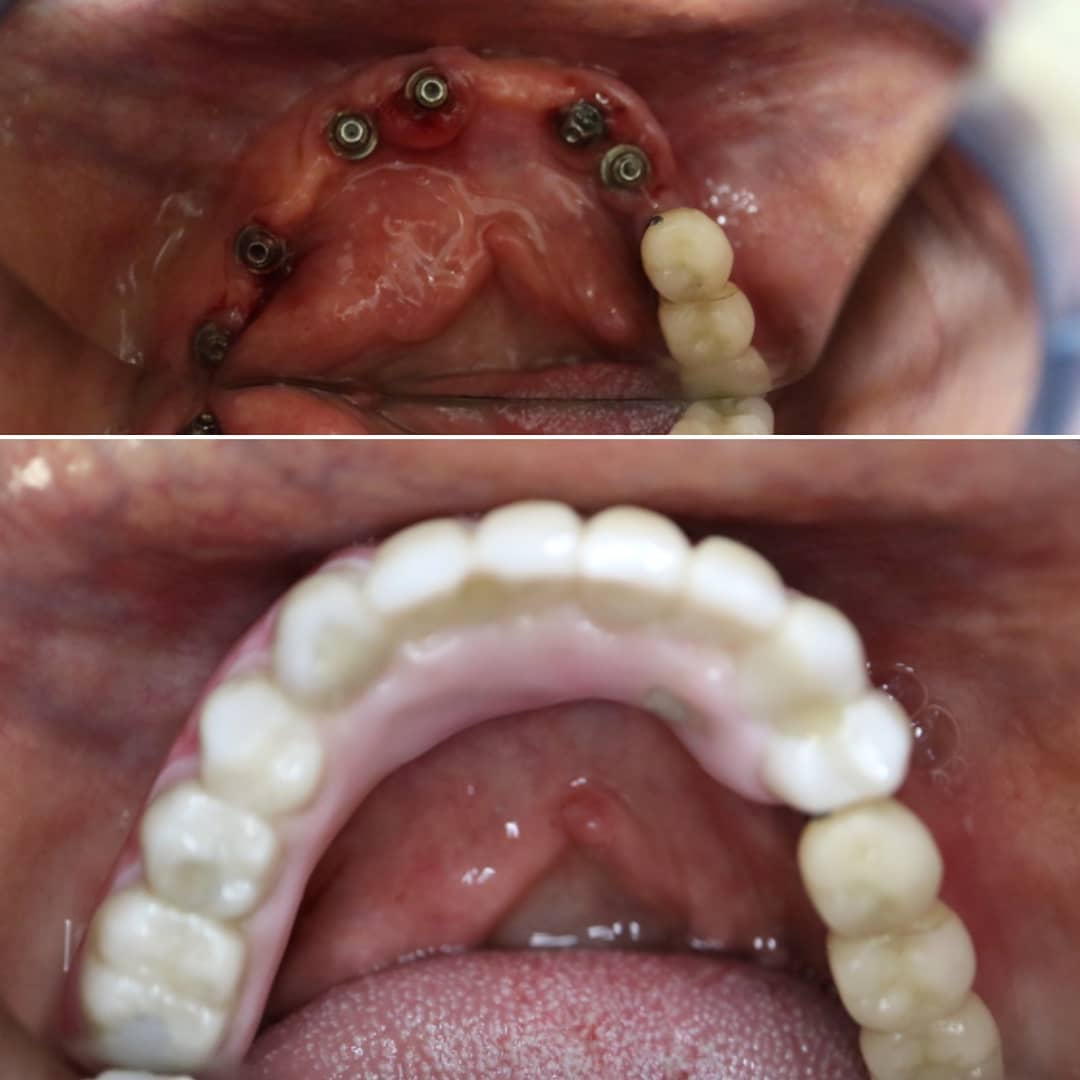 Implant supported hybrid denture bridge