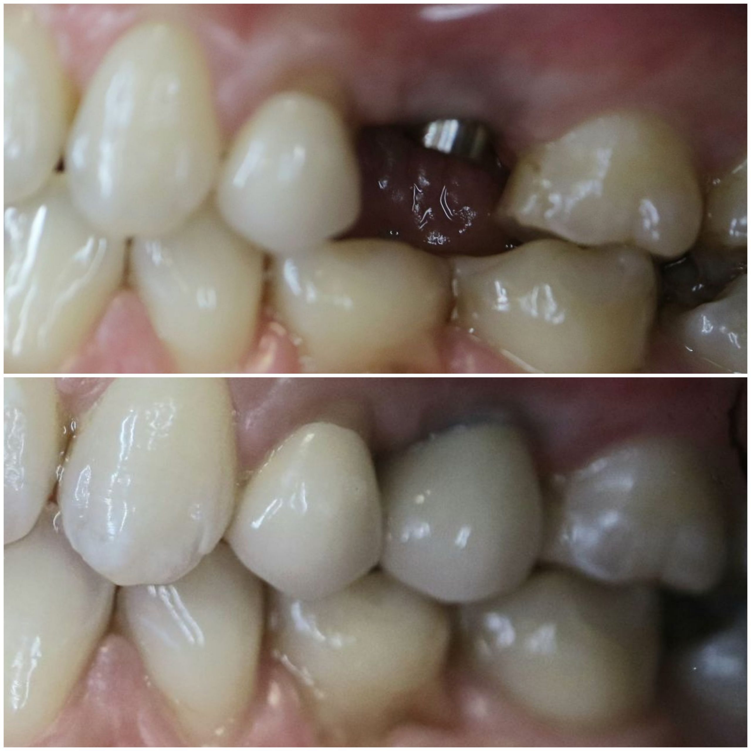Single dental implant before and after