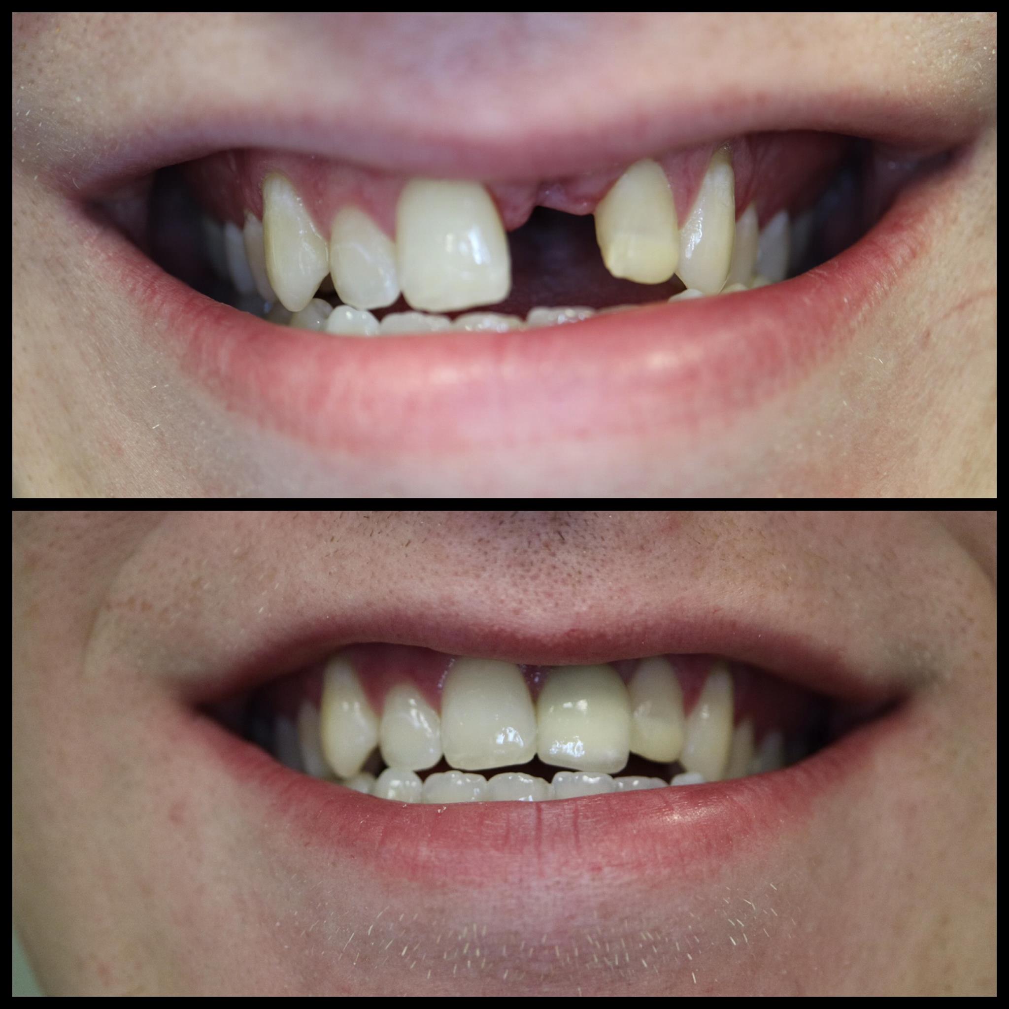 Dental implants before and after Park Ridge