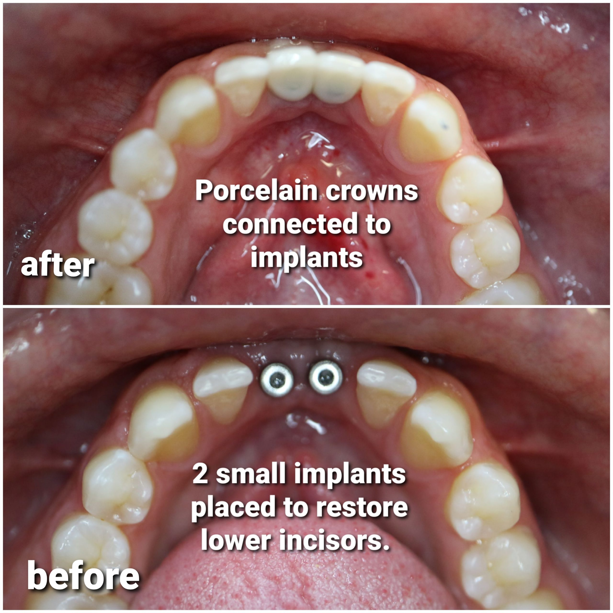 Multiple dental implants Park Ridge