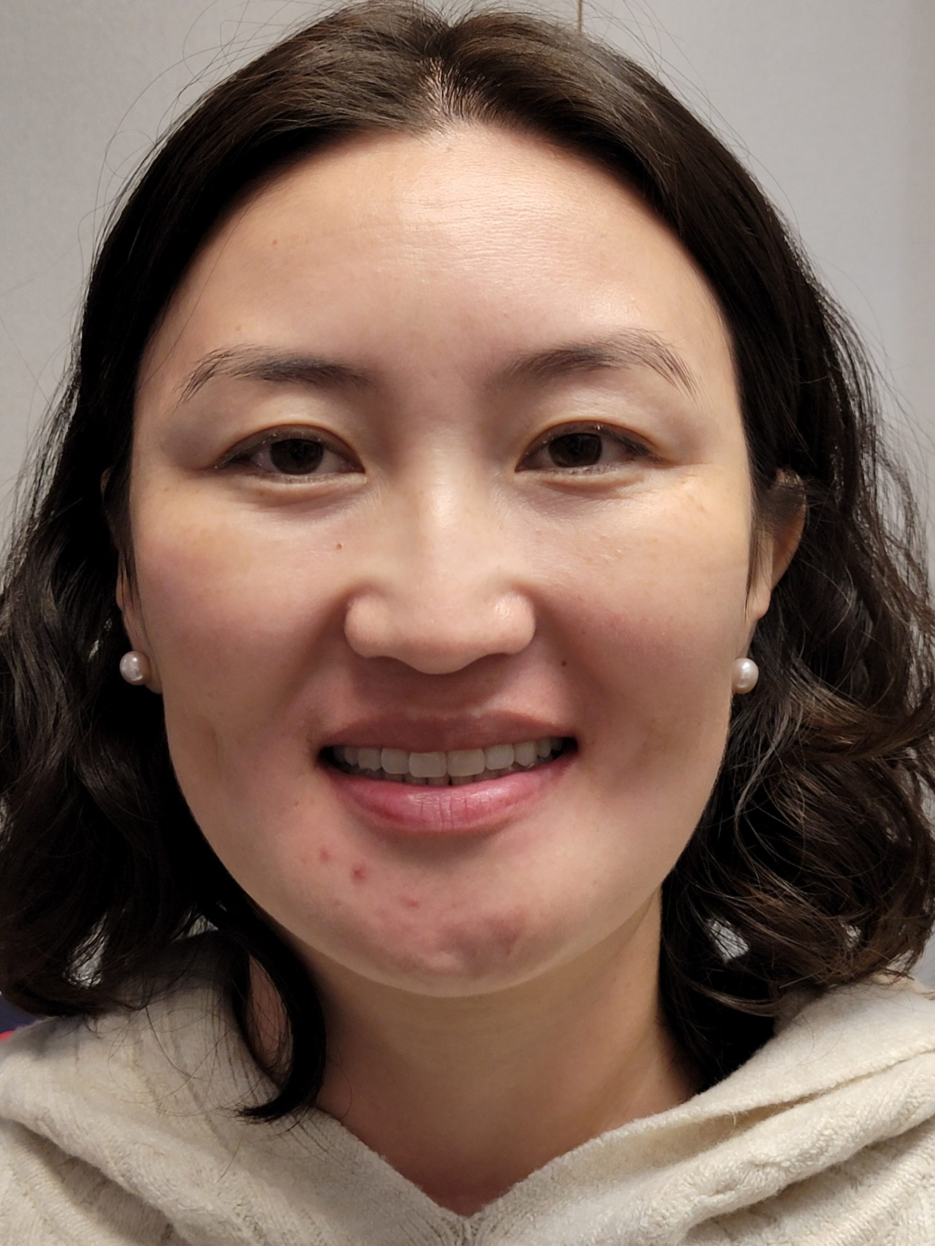 Invisalign results patient