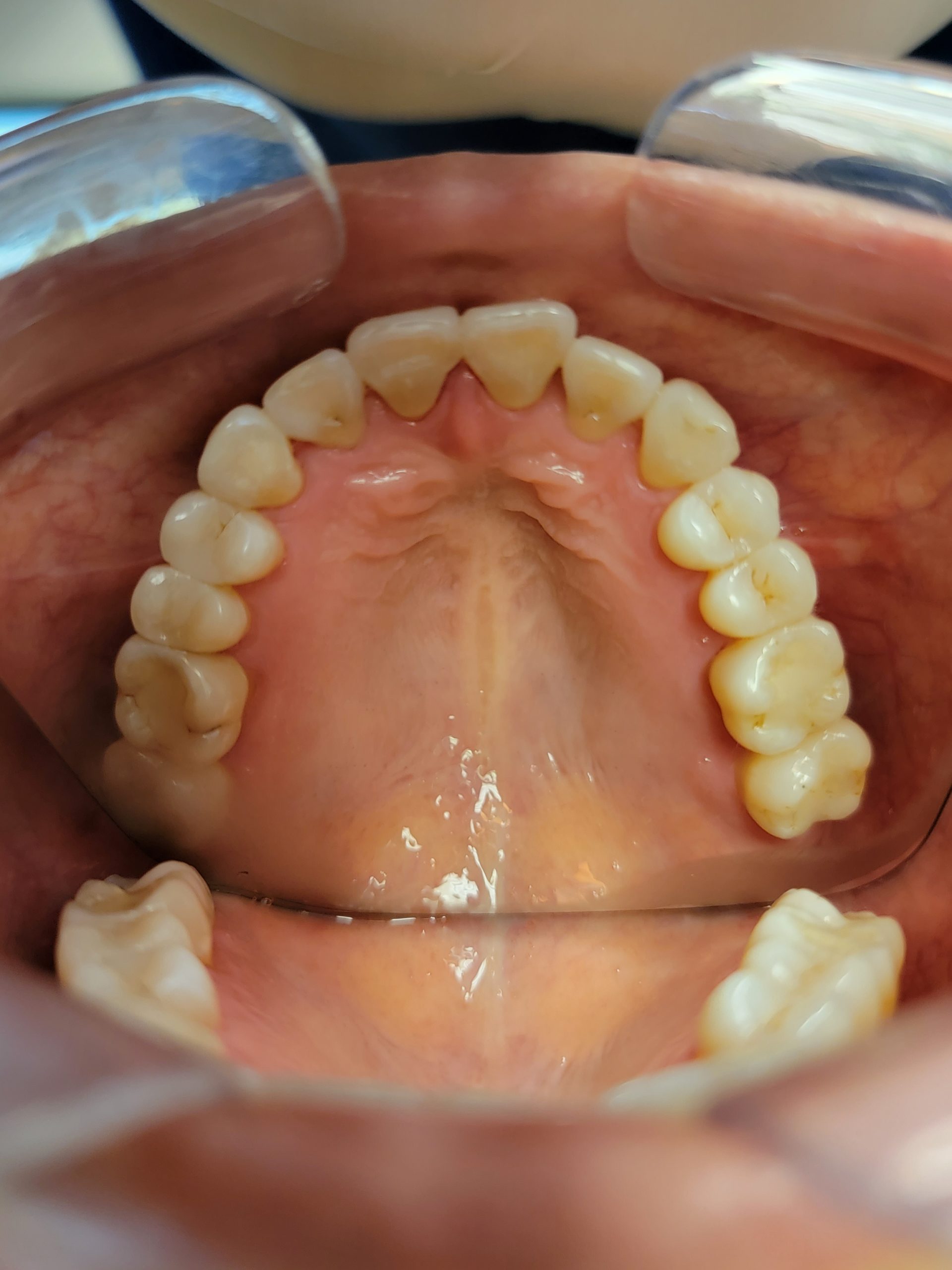 Invisalign clear aligner results