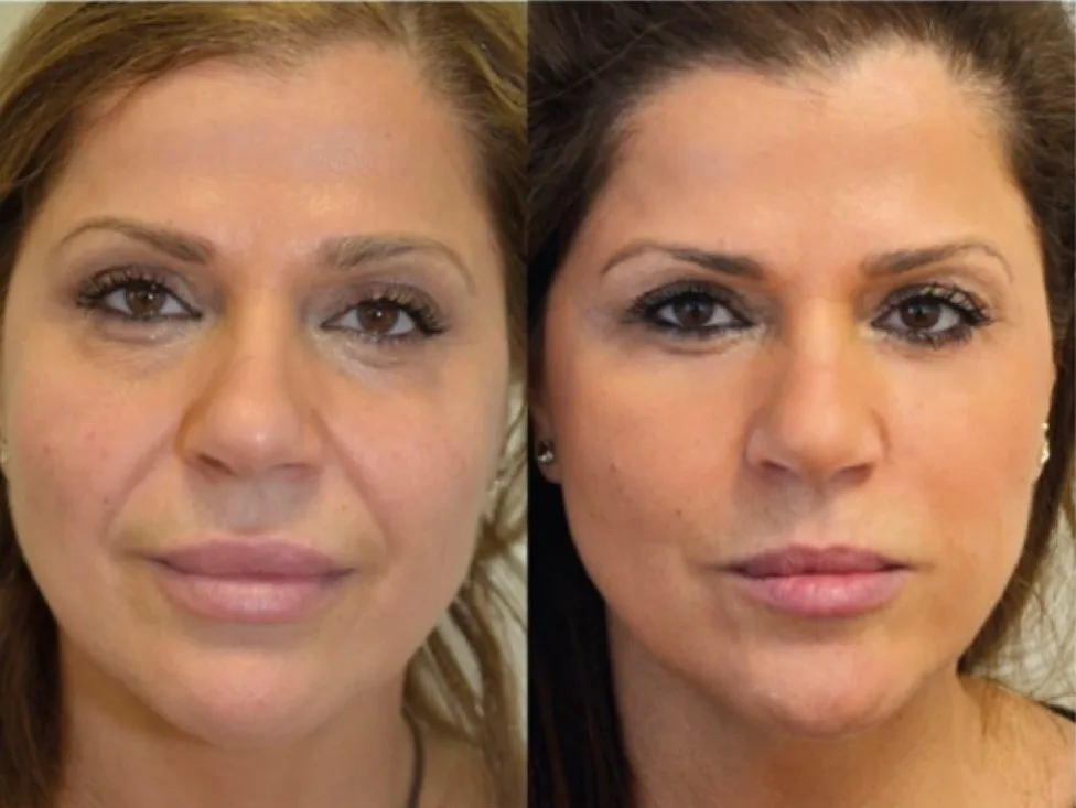 PDO thread lift before and after facial contouring result at Loukas Dentistry in Park Ridge
