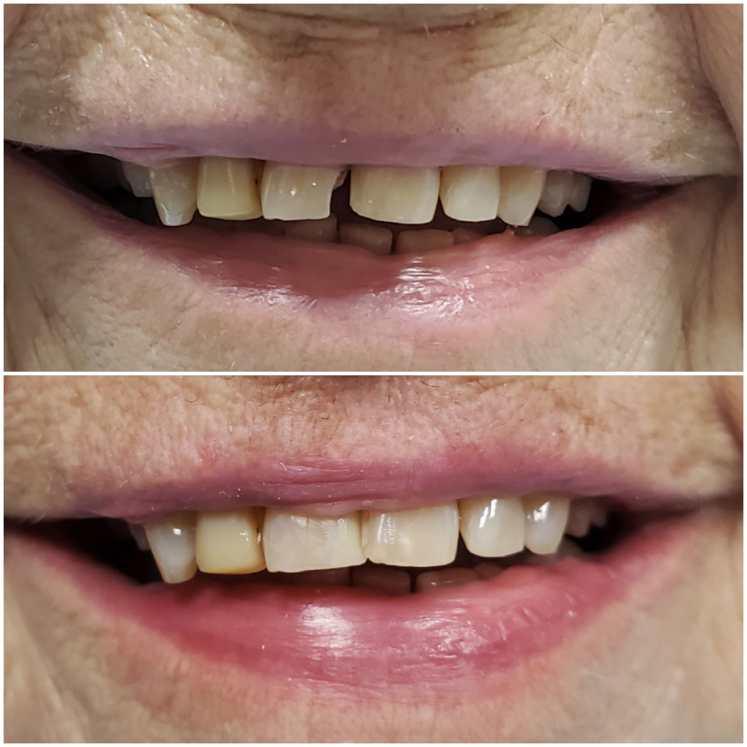 Dental bonding before and after
