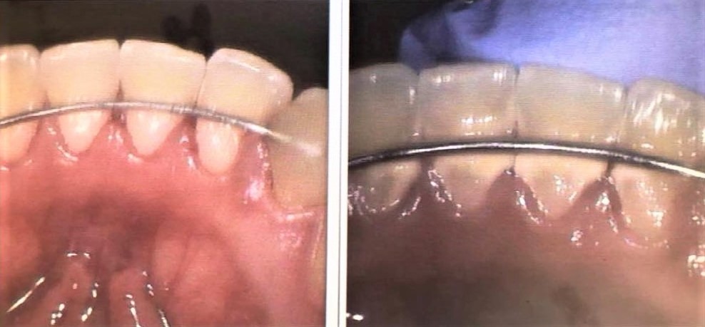 Dental cleaning and preventive care at Loukas Dentistry in Park Ridge IL
