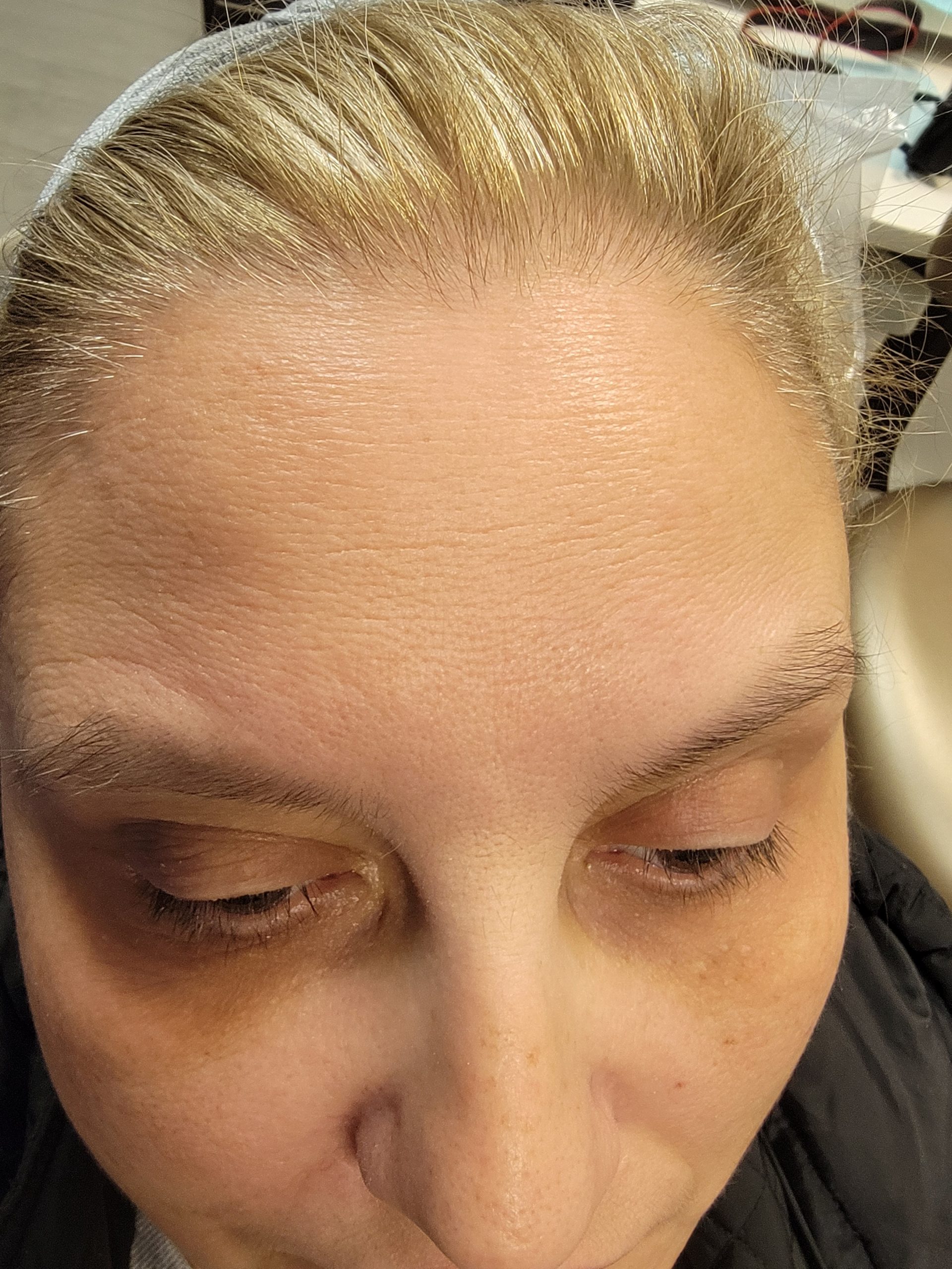 Botox before treatment - Park Ridge patient
