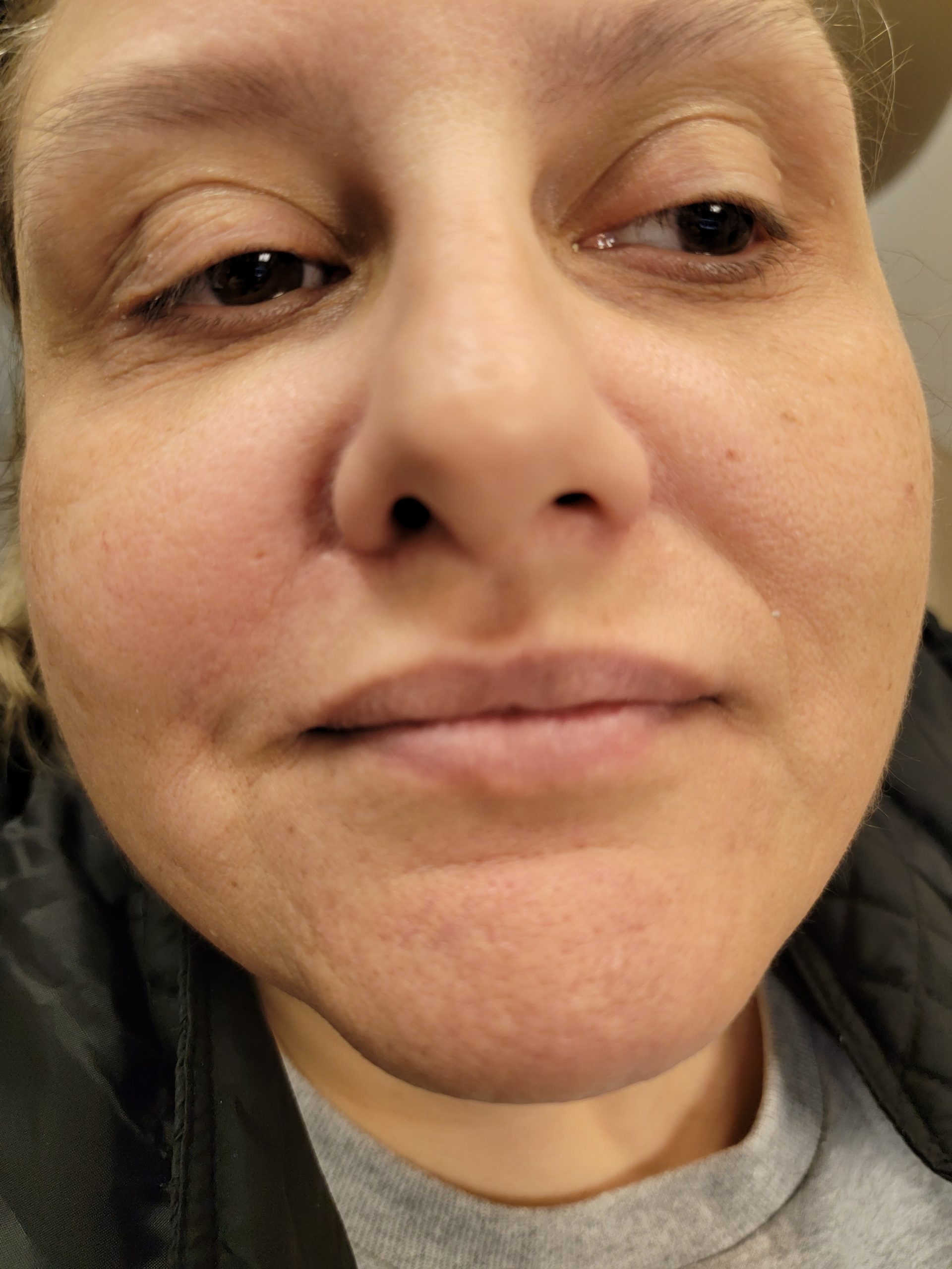 Botox after treatment results