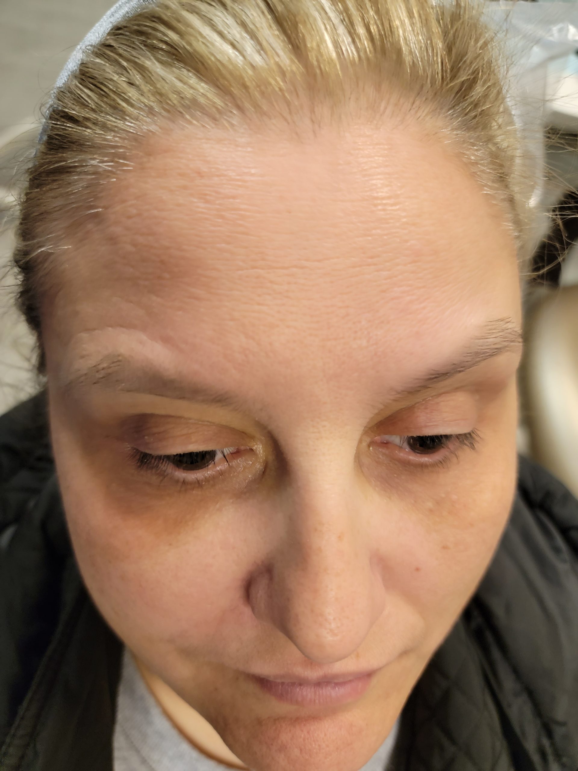 Botox results Park Ridge