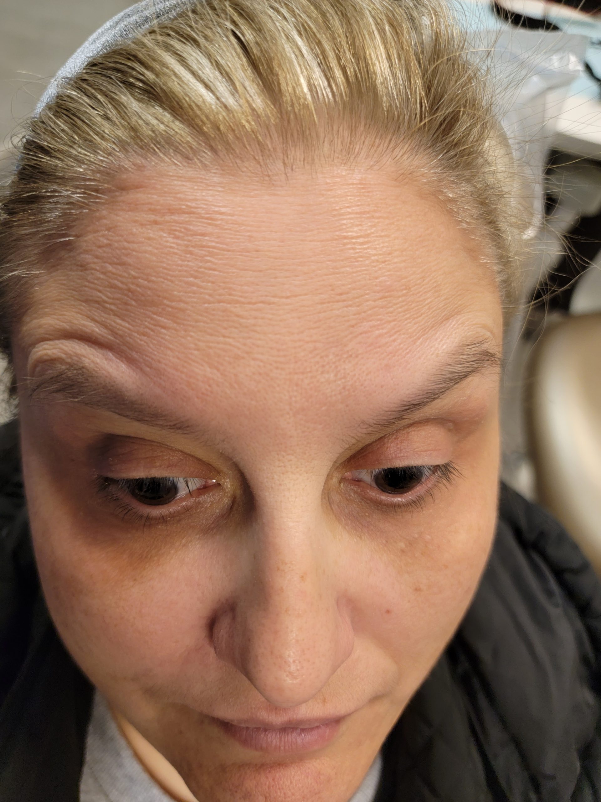 Botox treatment Loukas Dentistry