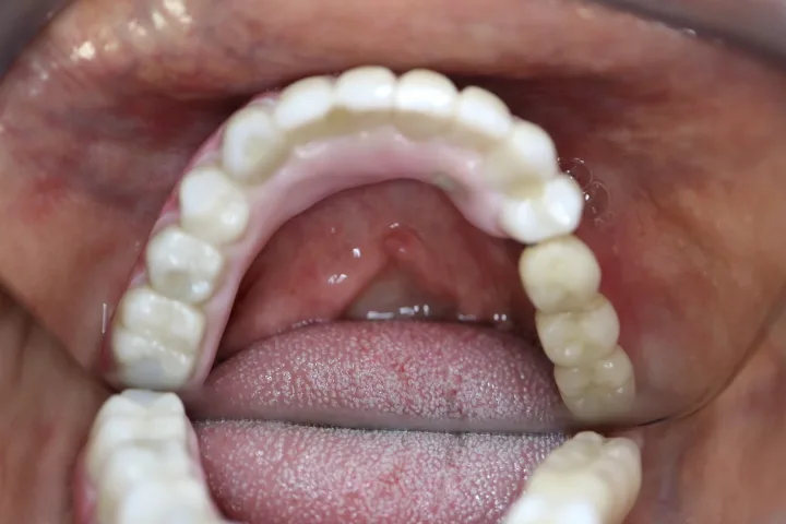 Completed full arch upper restoration supported by dental implants, Loukas Dentistry of Park Ridge, Illinois