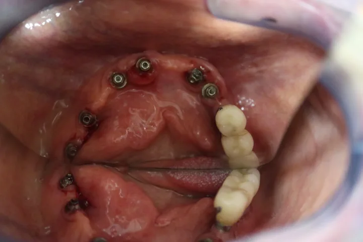 Upper jaw before the final restoration, with dental implants placed and healing abutments visible along the ridge, Loukas Dentistry of Park Ridge, Illinois