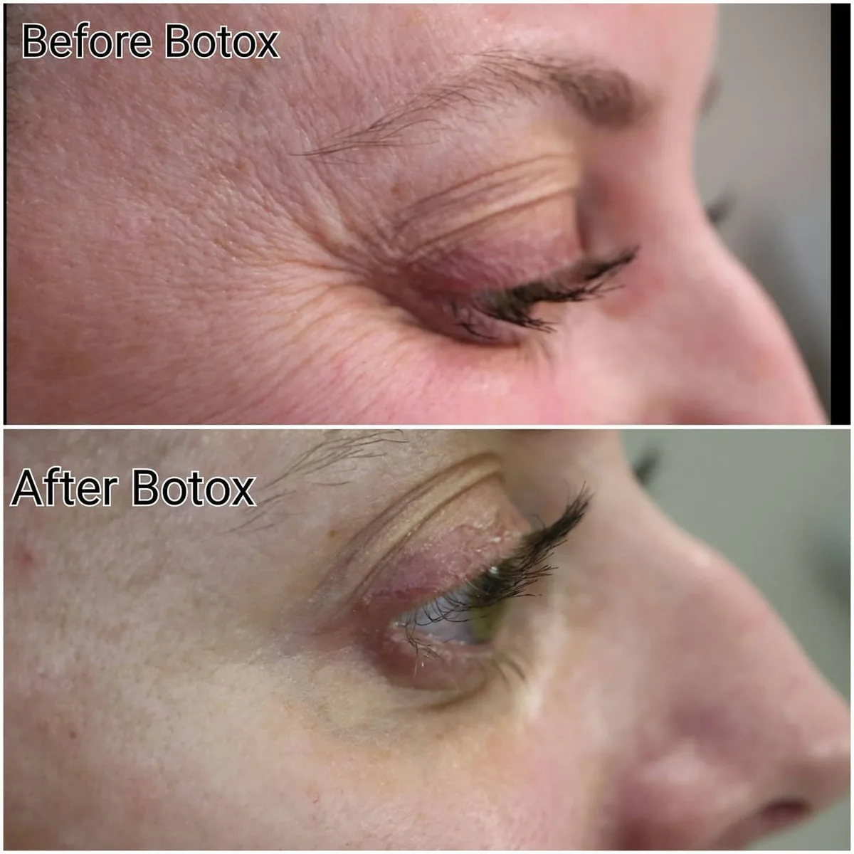 Before and after Botox treatment softening crow's feet lines at the outer corner of the eye, Loukas Dentistry of Park Ridge, Illinois