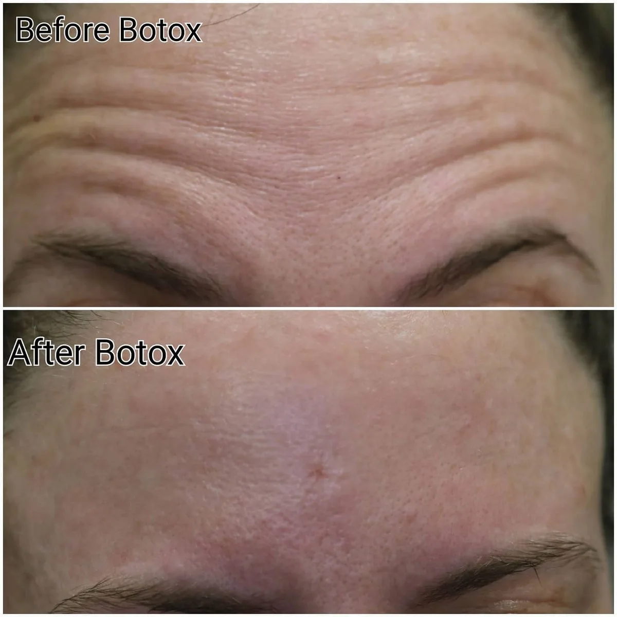 Before and after Botox treatment smoothing horizontal forehead lines, Loukas Dentistry of Park Ridge, Illinois
