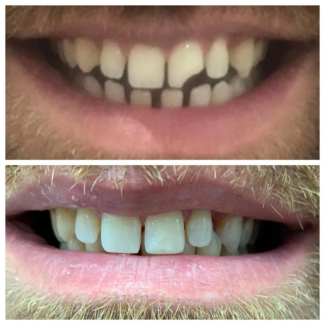 Before and after tooth colored composite bonding closing gaps between the upper front teeth, Loukas Dentistry of Park Ridge, Illinois