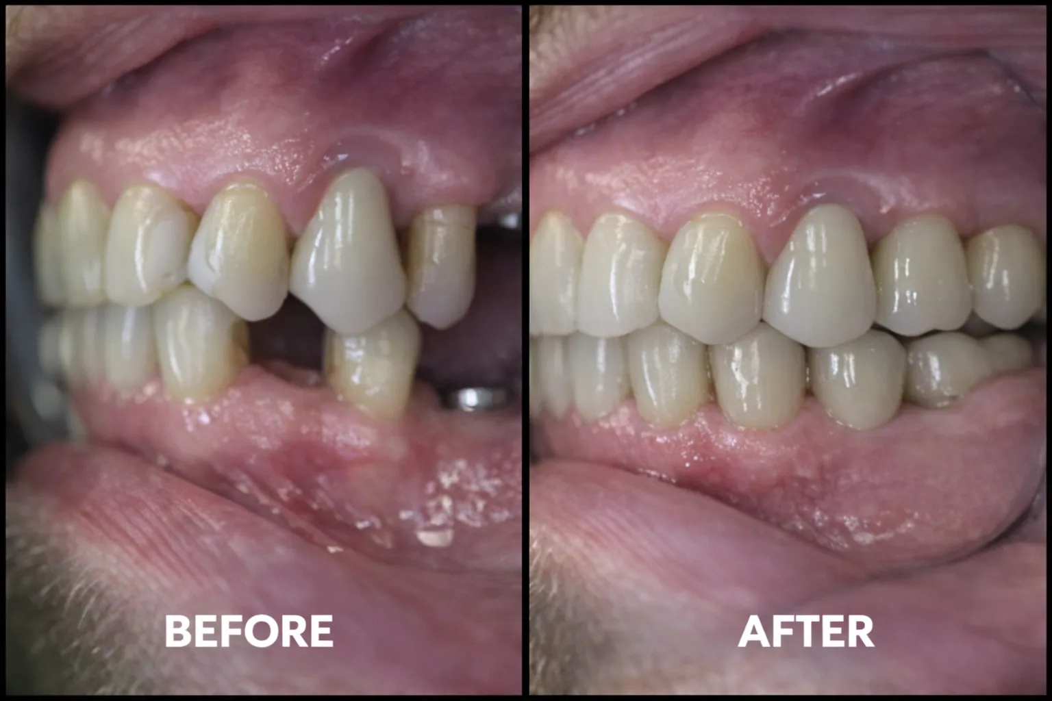 Before and after dental implant restoration replacing a missing back tooth with an implant supported crown, Loukas Dentistry of Park Ridge, Illinois