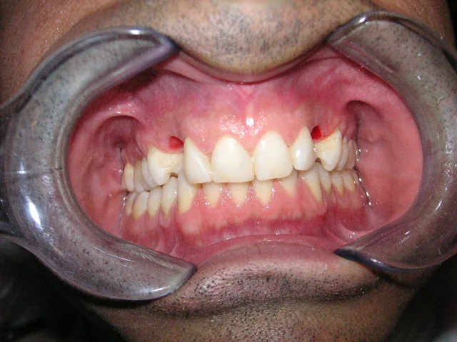 Before Implant supported bridge