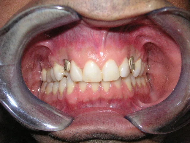 After Implant supported bridge
