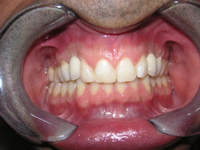 Before Implant restoration case