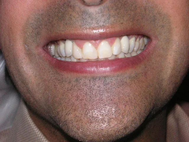 After Implant restoration case