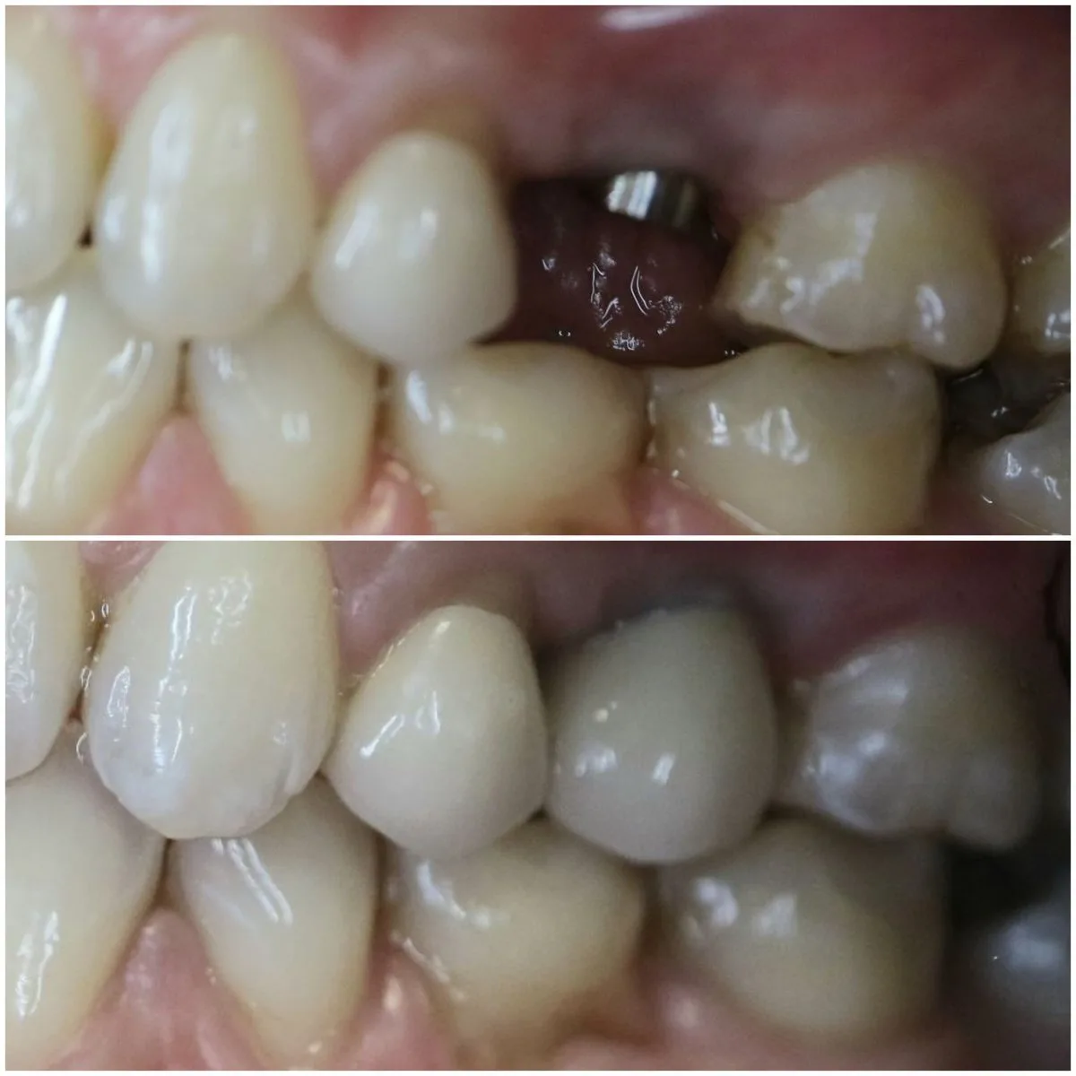 Before and after single dental implant, showing the implant abutment and the finished crown on a back tooth, Loukas Dentistry of Park Ridge, Illinois