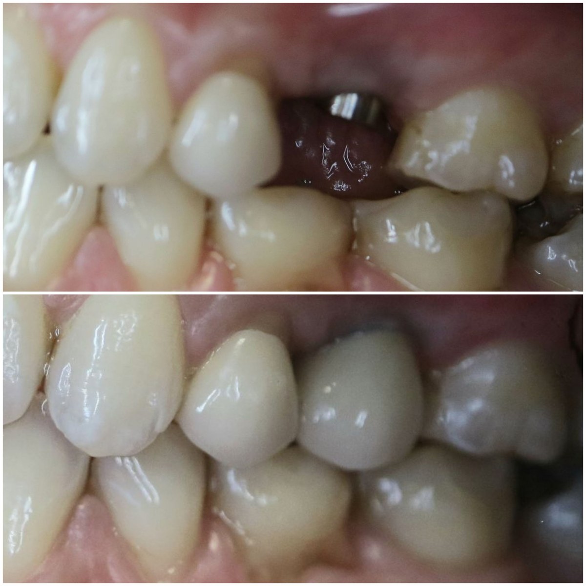 Single tooth dental implant before and after crown restoration