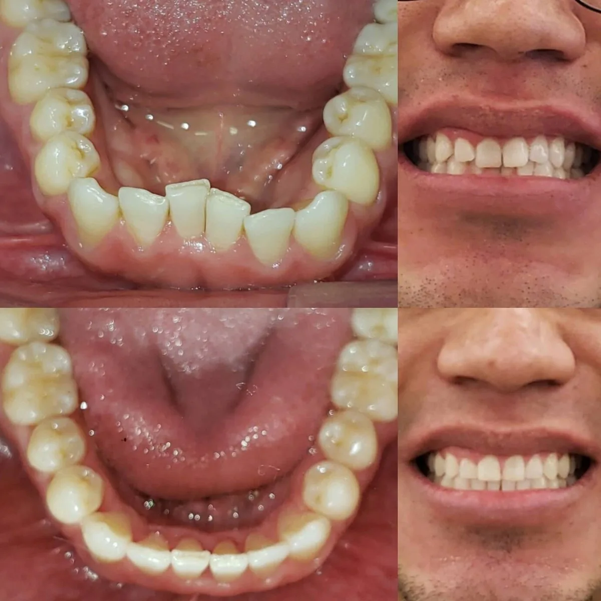 After Invisalign treatment results