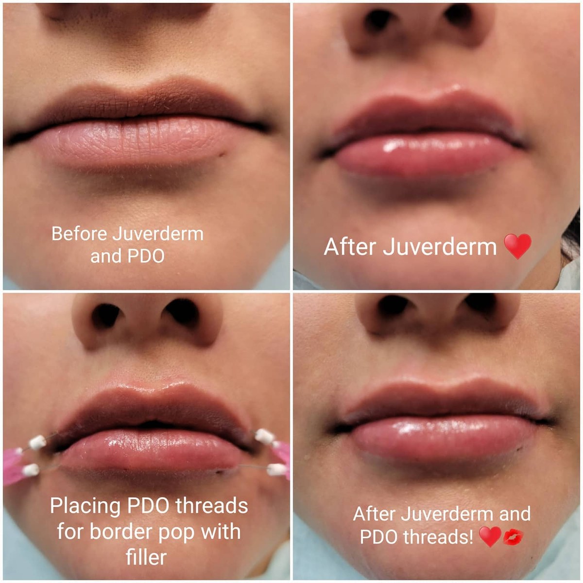 Lip filler before and after results Park Ridge