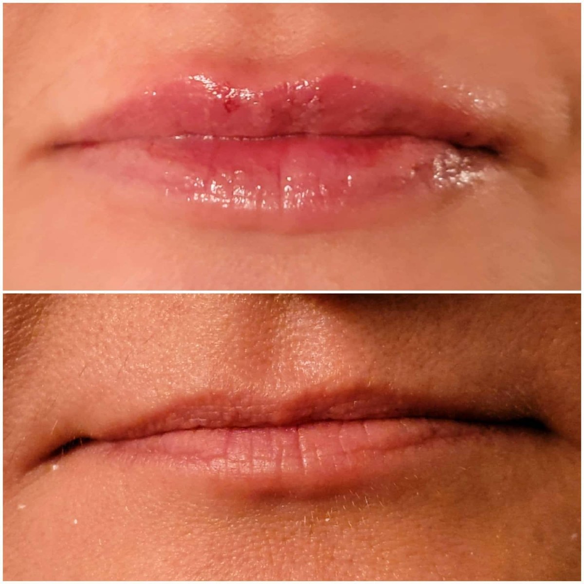 Juvederm before and after lip augmentation